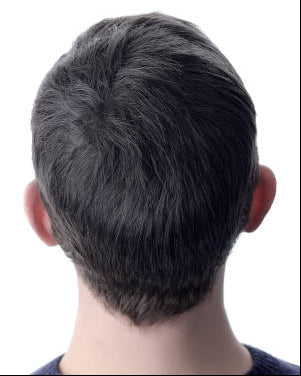 After - 2 Months Results