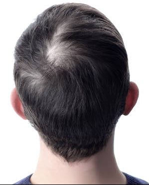 Before - 2 Months Results